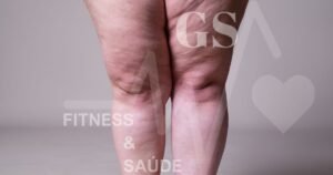 lipedema